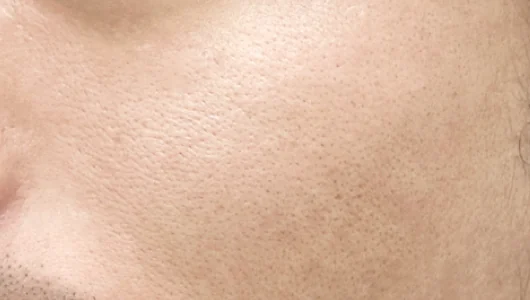 顔の毛穴が目立つ肌のクローズアップ