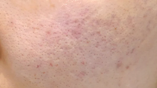 毛穴が目立つ肌のクローズアップ写真