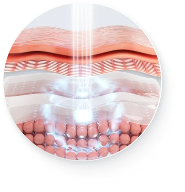 肌の断面図と、光線が内部に届いている様子