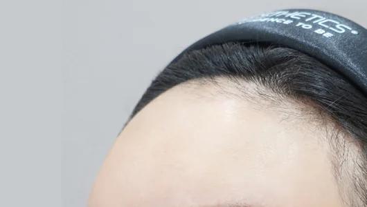 ヒアルロン酸フィラー施術後の額のクローズアップ写真