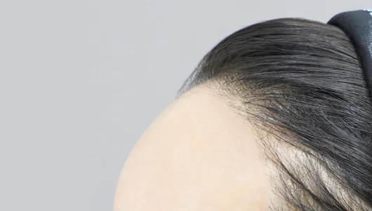 ヒアルロン酸注入後の額の輪郭と髪の生え際