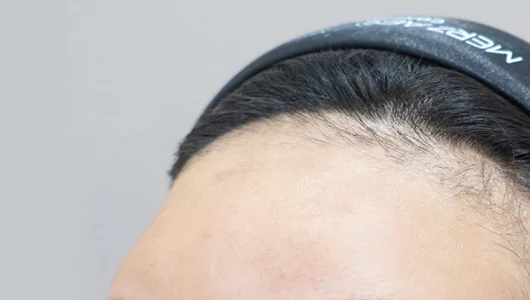 ヒアルロン酸フィラー注入前の額の状態。