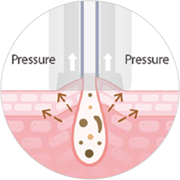 毛穴の汚れを圧搾するメカニズムの図解