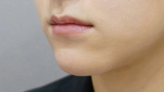 リップフィラー施術前の唇のクローズアップ写真