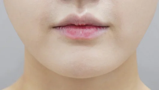 唇のフィラー施術前の状態を示す顔の一部。