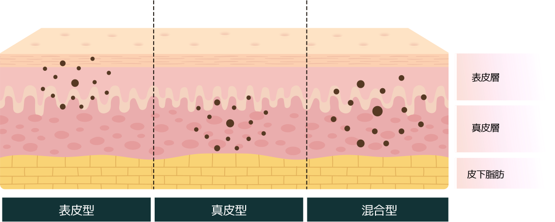 ピコトーニング治療の図解：表皮型、真皮型、混合型におけるメラニンの分布を示す。