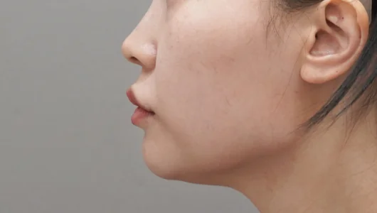 女性の顔の横顔、チタンリフティング手術前